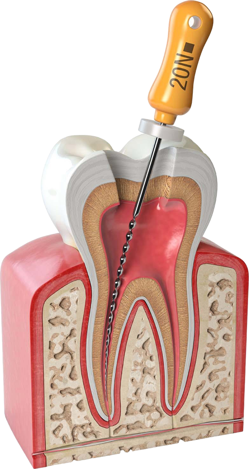 Endodoncija - Specijalistička stomatološka ordinacija Oluški - Ilić, Novi Sad